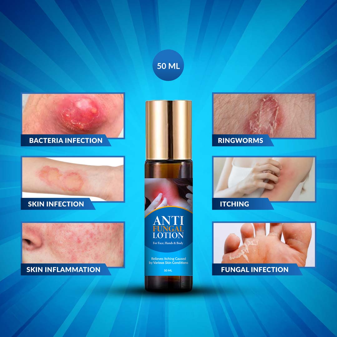 ANTI FUNGAL LOTION